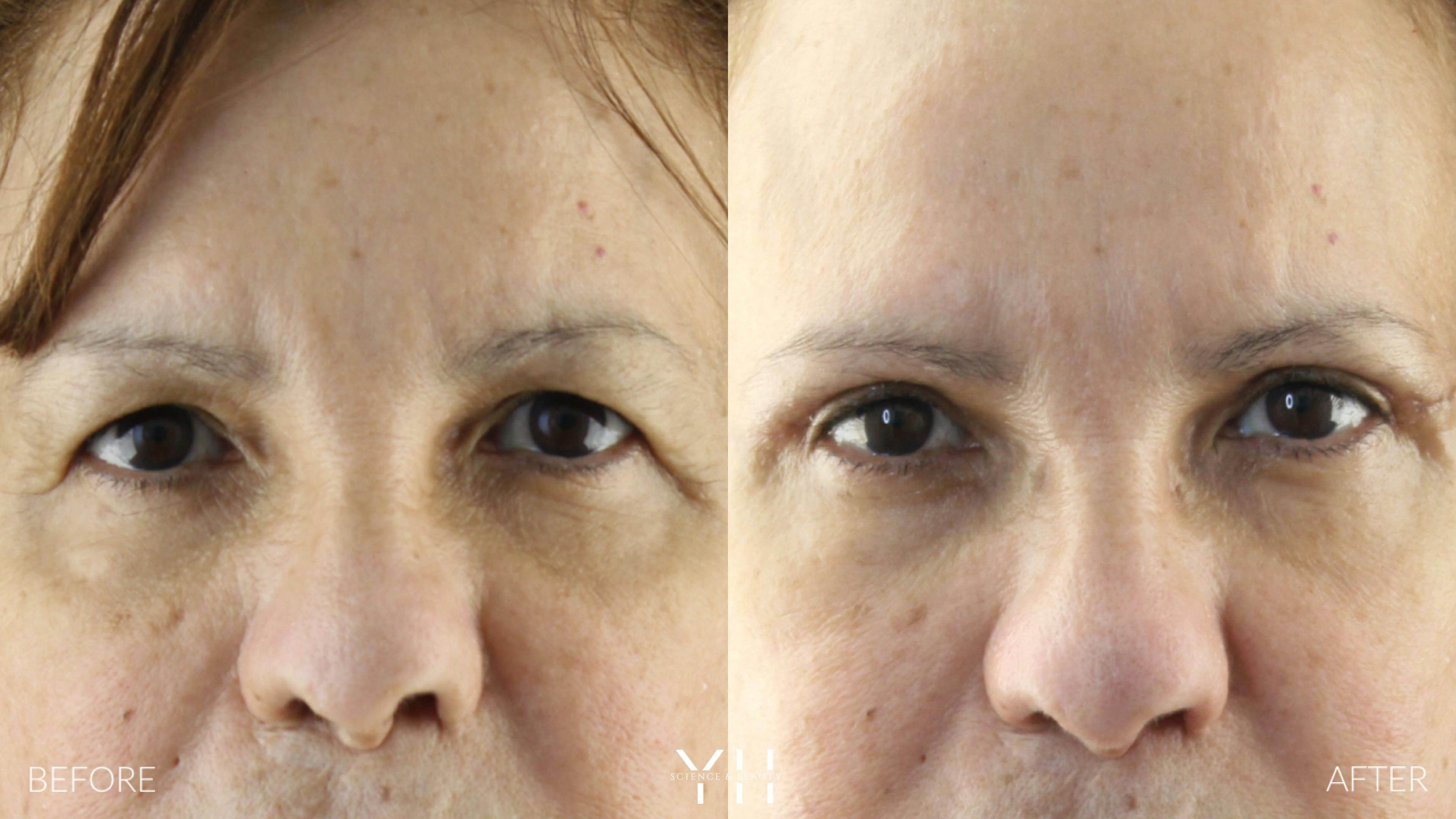 Before and After Eyelid Surgery
