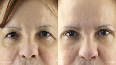  Blepharoplasty Before & After Gallery - Patient 210265 - Image 1