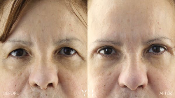  Blepharoplasty Before & After Gallery - Patient 210265 - Image 1