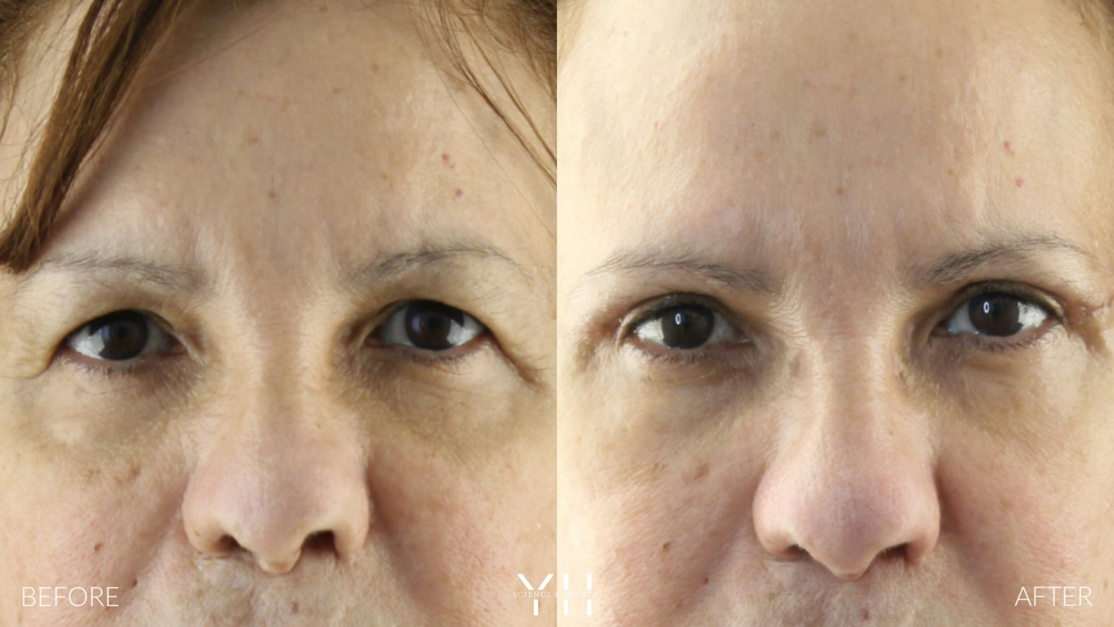 Blepharoplasty Before & After Gallery - Patient 210265 - Image 1