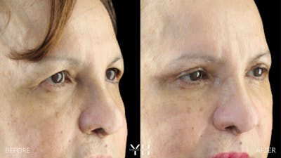 Blepharoplasty Before & After Gallery - Patient 210265 - Image 2