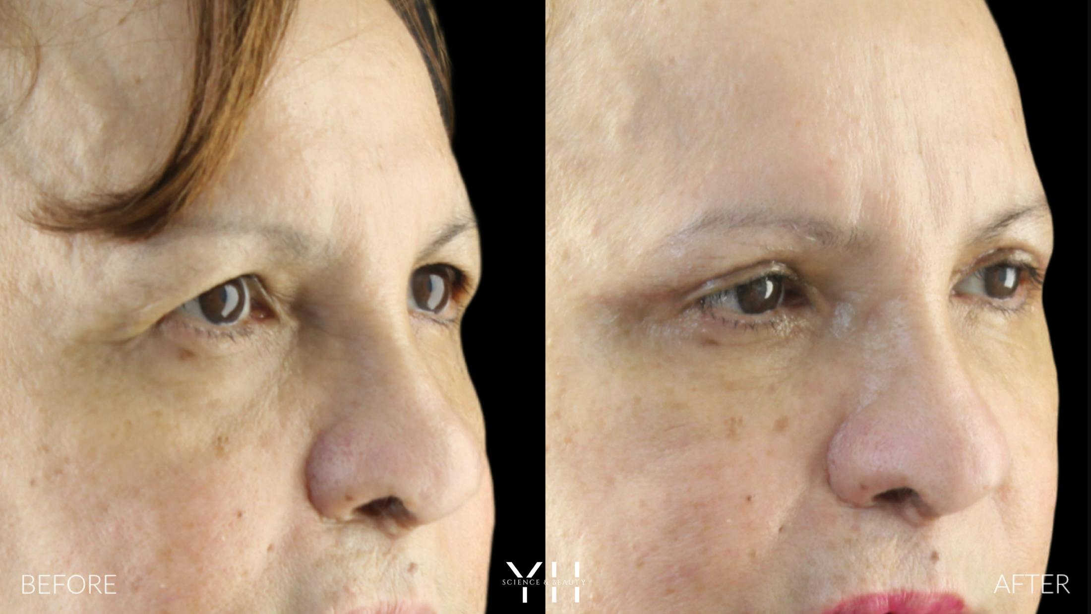 Blepharoplasty Before & After Gallery - Patient 210265 - Image 2