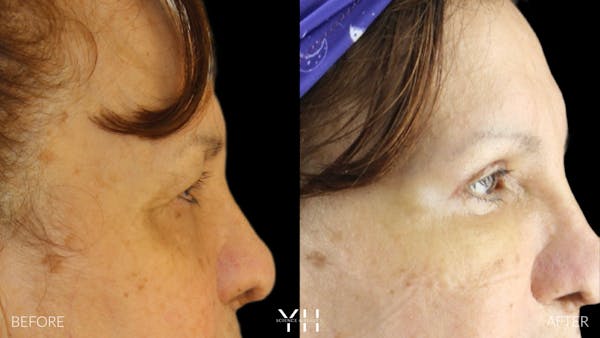  Blepharoplasty Before & After Gallery - Patient 210265 - Image 3