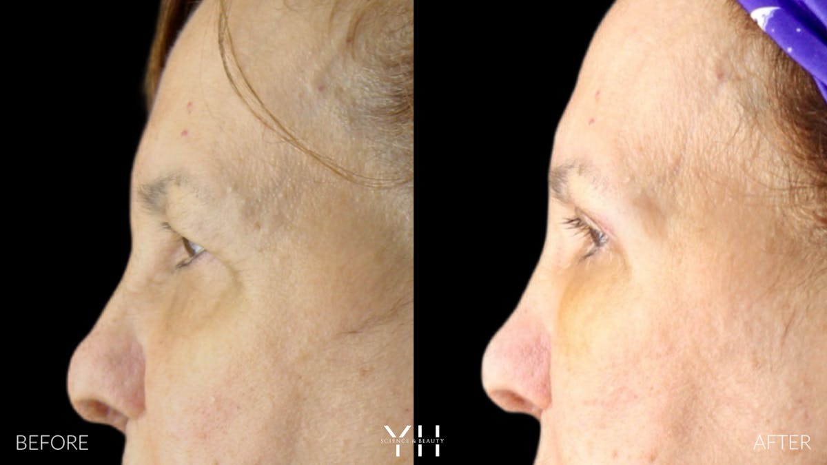  Blepharoplasty Before & After Gallery - Patient 210265 - Image 5
