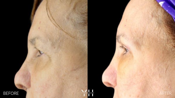  Blepharoplasty Before & After Gallery - Patient 210265 - Image 5