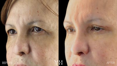  Blepharoplasty Before & After Gallery - Patient 210265 - Image 4