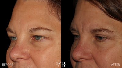  Blepharoplasty Before & After Gallery - Patient 328779 - Image 4