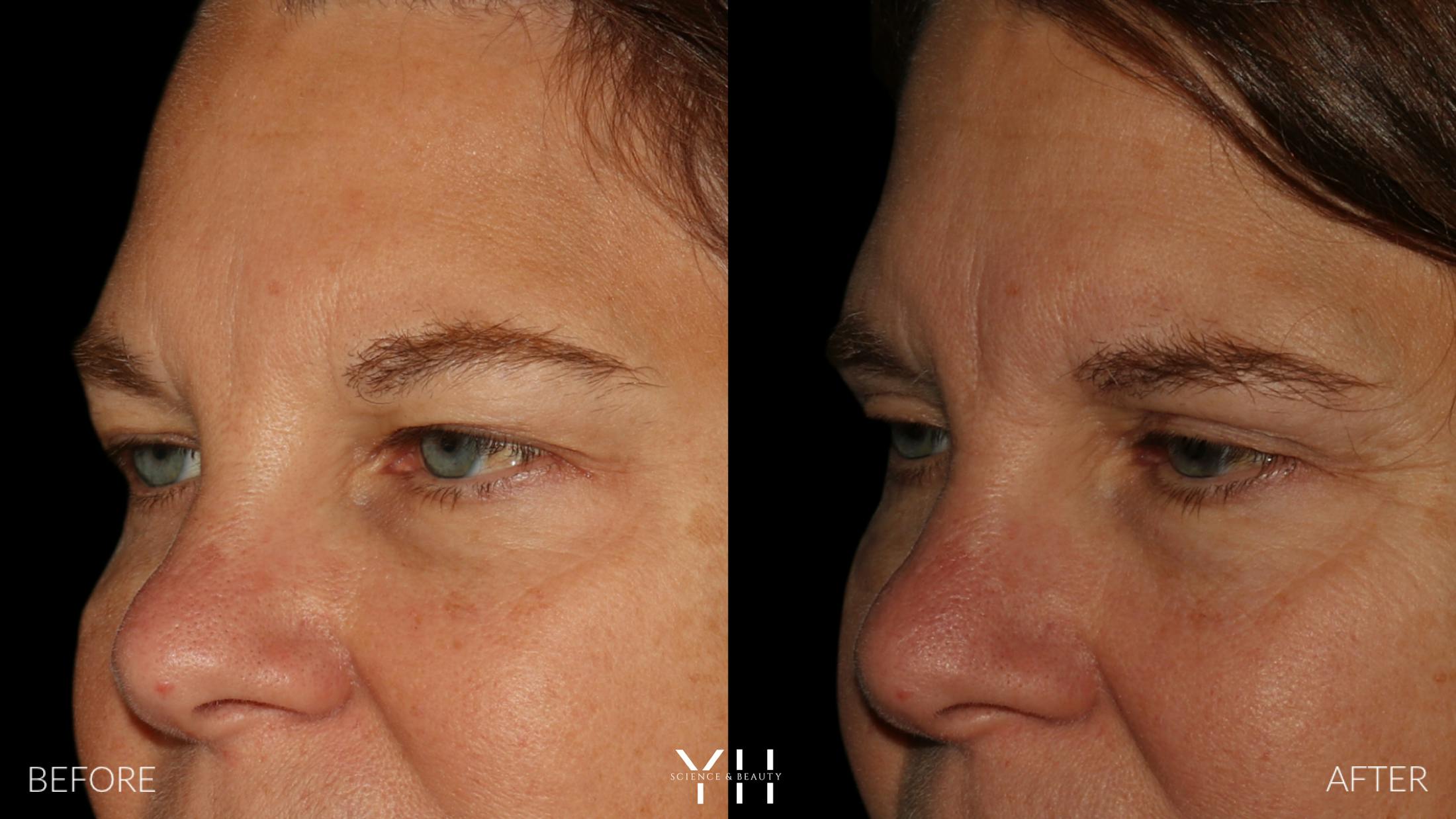 Blepharoplasty Before & After Gallery - Patient 328779 - Image 4