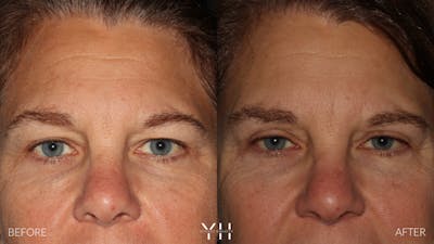  Blepharoplasty Before & After Gallery - Patient 328779 - Image 1