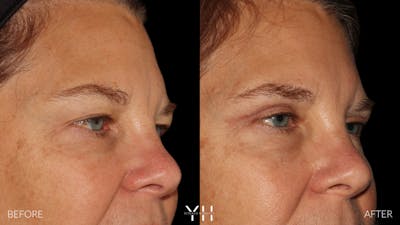  Blepharoplasty Before & After Gallery - Patient 328779 - Image 2