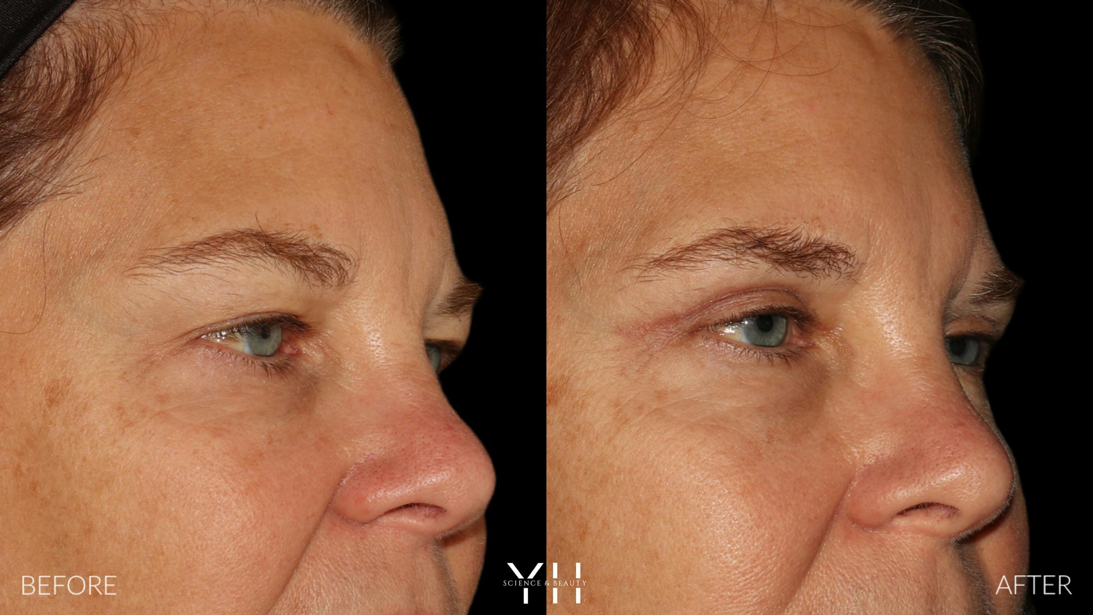 Blepharoplasty Before & After Gallery - Patient 328779 - Image 2