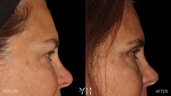  Blepharoplasty Before & After Gallery - Patient 328779 - Image 3