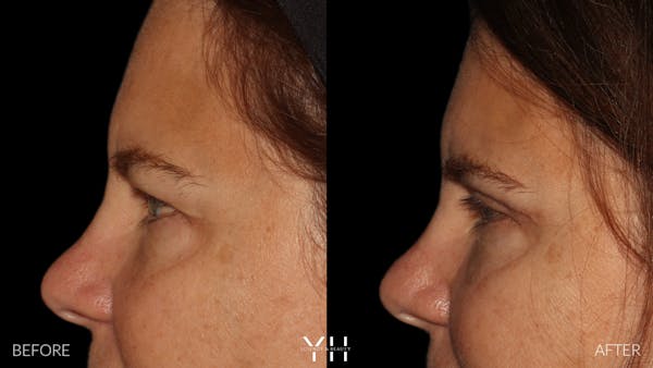  Blepharoplasty Before & After Gallery - Patient 328779 - Image 5