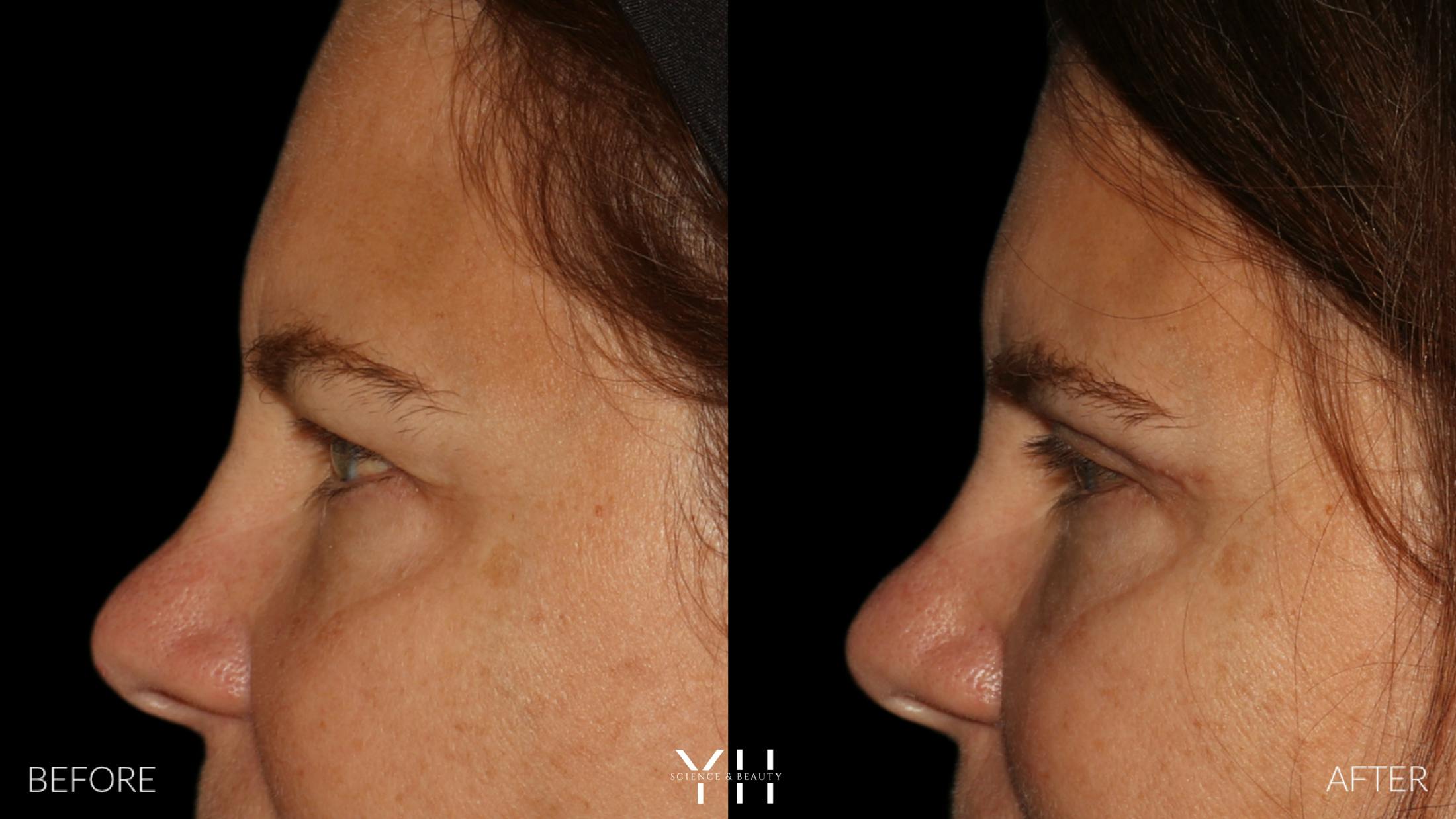 Blepharoplasty Before & After Gallery - Patient 328779 - Image 5
