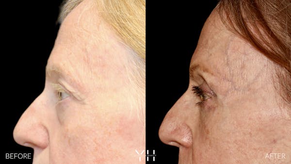  Blepharoplasty Before & After Gallery - Patient 380351 - Image 5