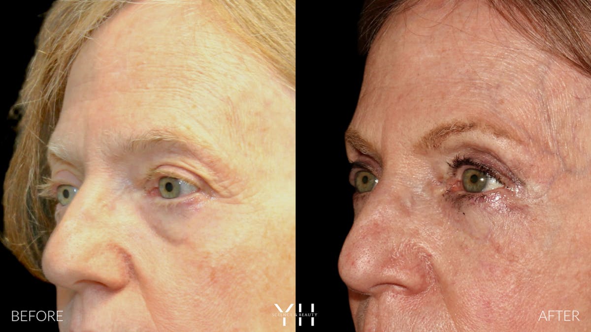  Blepharoplasty Before & After Gallery - Patient 380351 - Image 4