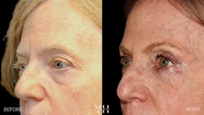  Blepharoplasty Before & After Gallery - Patient 380351 - Image 4