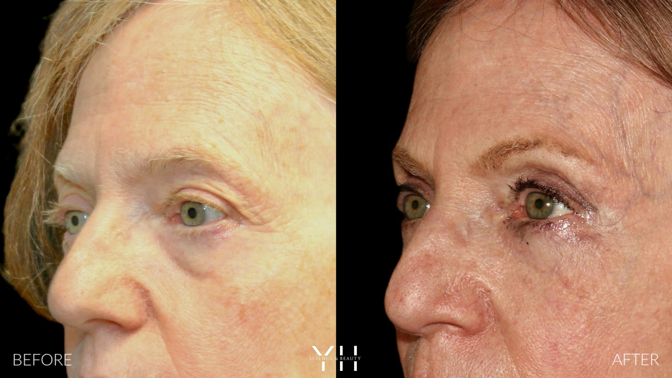 Blepharoplasty Before & After Gallery - Patient 380351 - Image 4