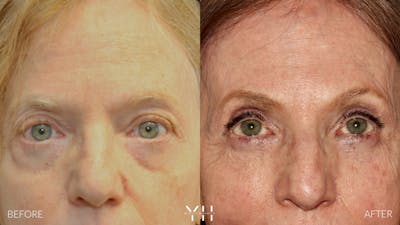  Blepharoplasty Before & After Gallery - Patient 380351 - Image 1