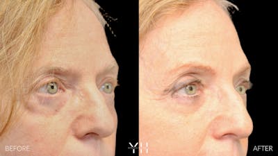  Blepharoplasty Before & After Gallery - Patient 380351 - Image 2
