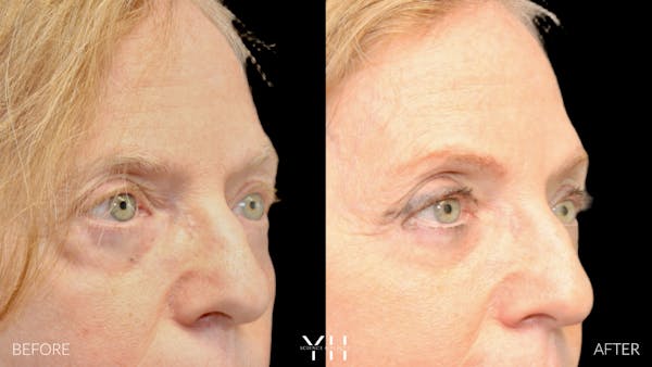  Blepharoplasty Before & After Gallery - Patient 380351 - Image 2