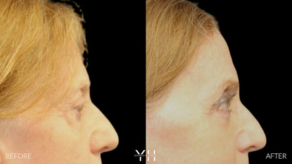  Blepharoplasty Before & After Gallery - Patient 380351 - Image 3