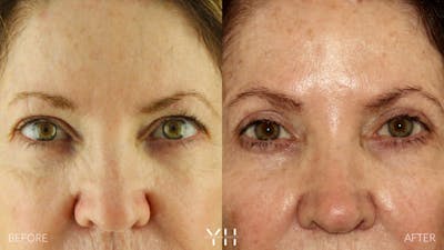  Blepharoplasty Before & After Gallery - Patient 736843 - Image 1