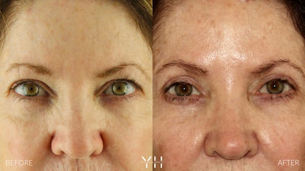  Blepharoplasty Before & After Gallery - Patient 736843 - Image 1