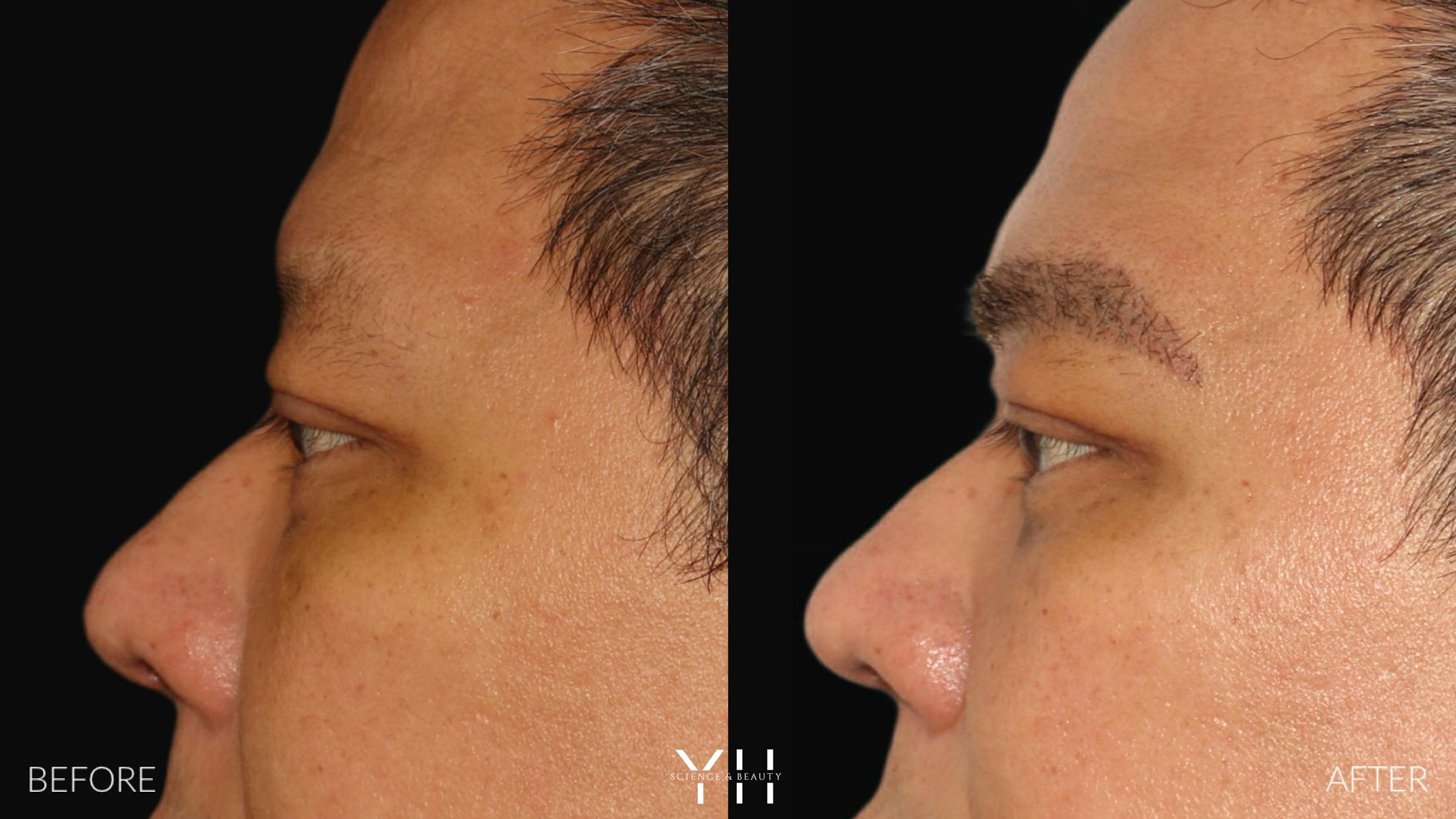 Eyebrow Transplant Before & After Gallery - Patient 381172 - Image 5