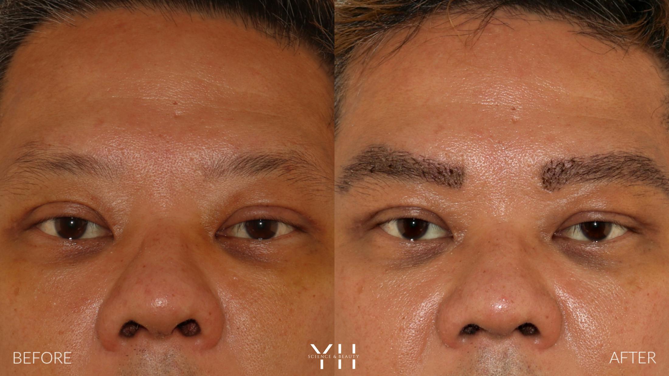 Eyebrow Transplant Before & After Gallery - Patient 381172 - Image 1