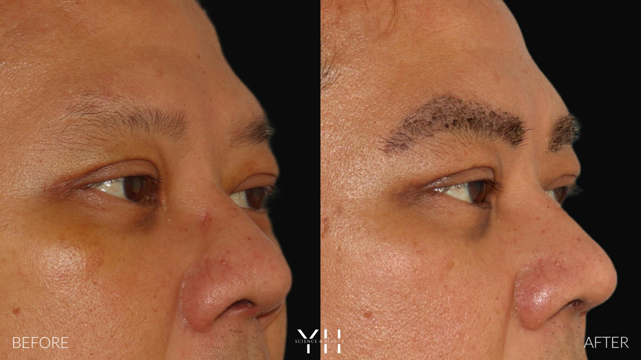 Eyebrow Transplant Before & After Gallery - Patient 381172 - Image 2