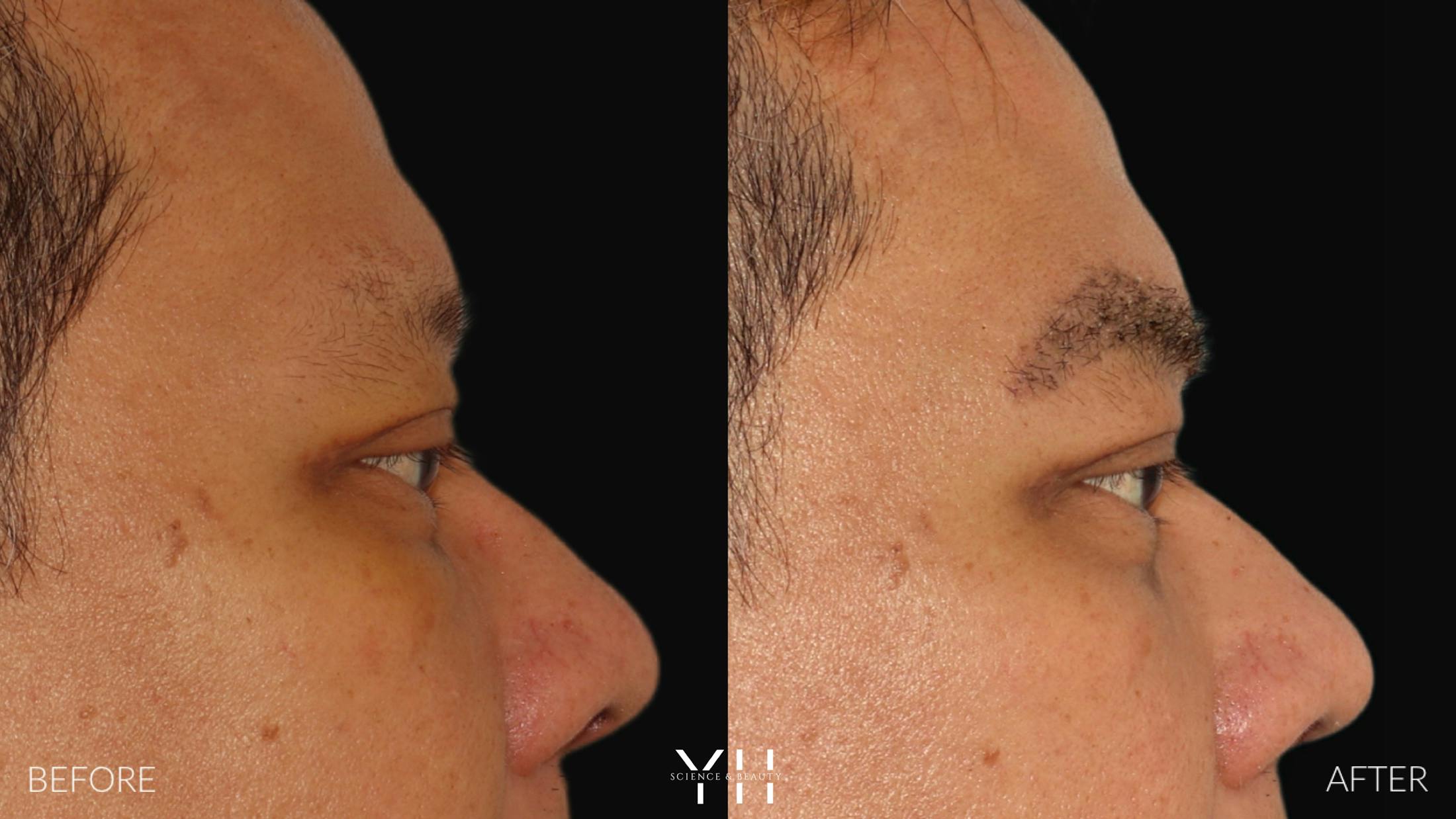 Eyebrow Transplant Before & After Gallery - Patient 381172 - Image 3