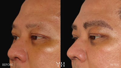 Eyebrow Transplant Before & After Gallery - Patient 381172 - Image 4