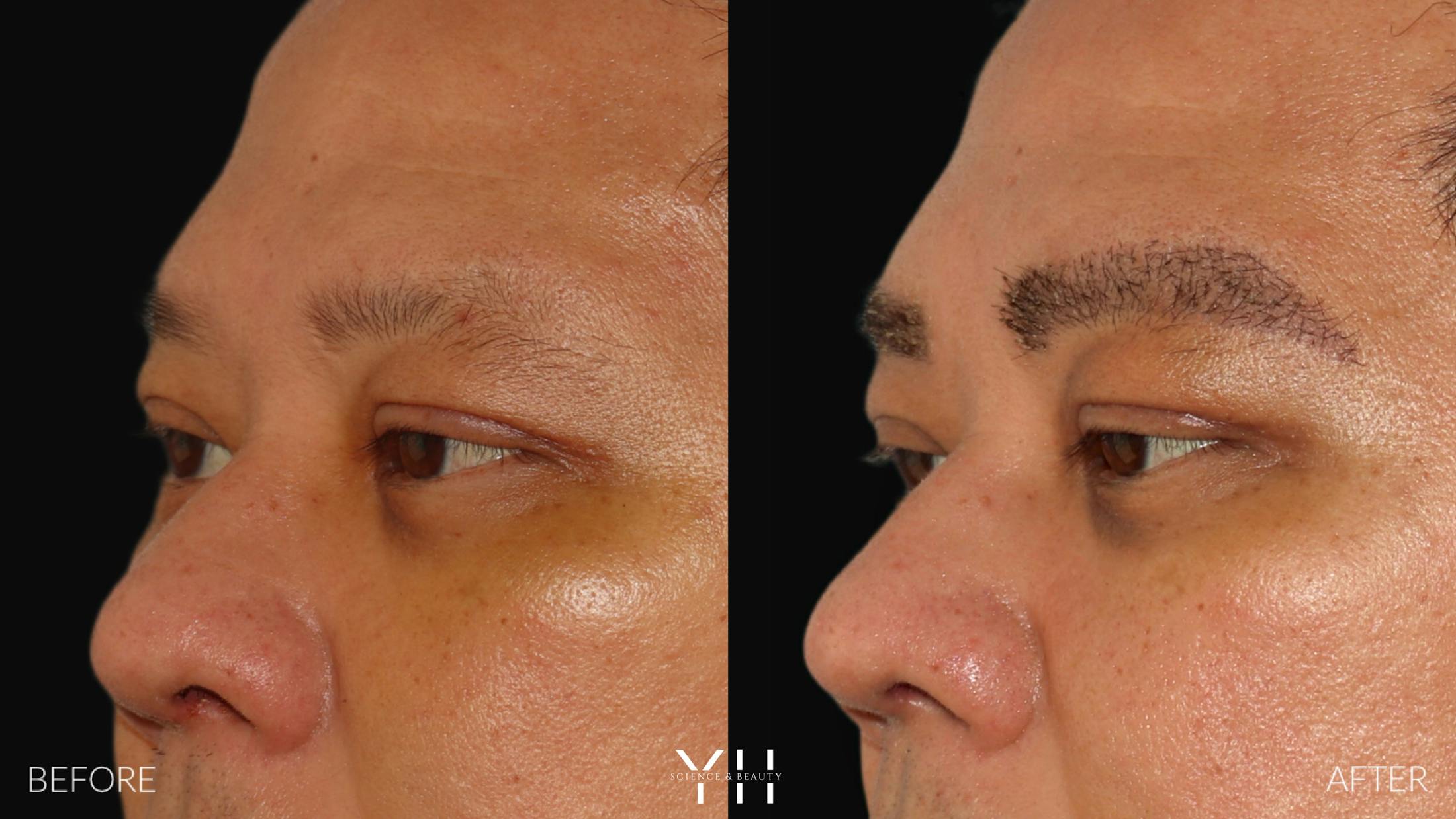 Eyebrow Transplant Before & After Gallery - Patient 381172 - Image 4