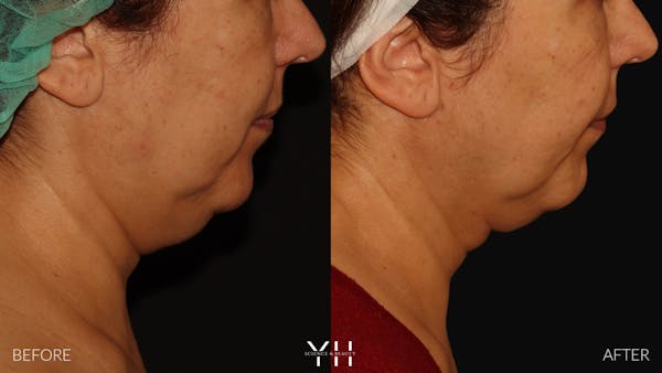 Necklift Before & After Gallery - Patient 212115 - Image 10