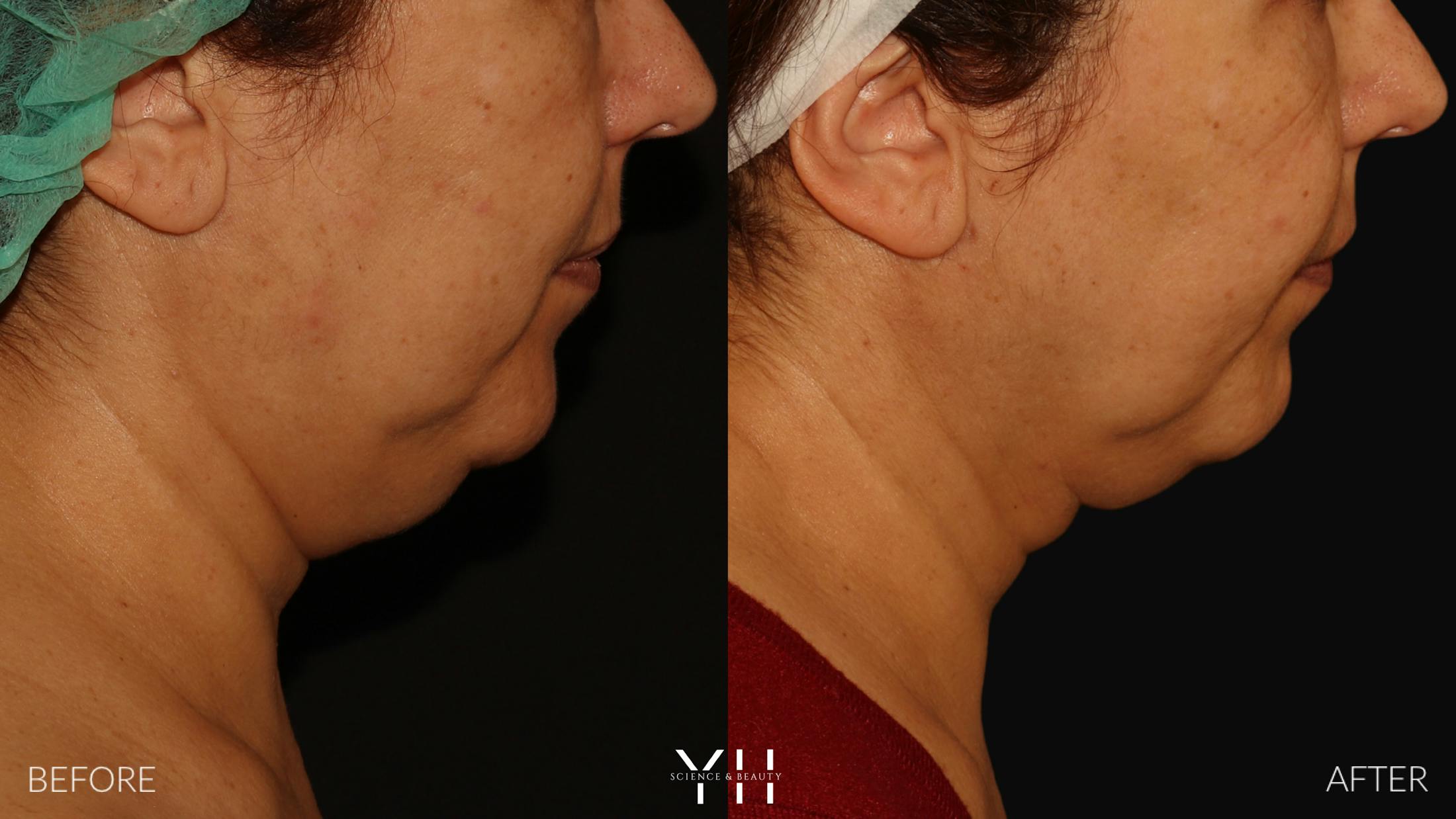Necklift Before & After Gallery - Patient 212115 - Image 10