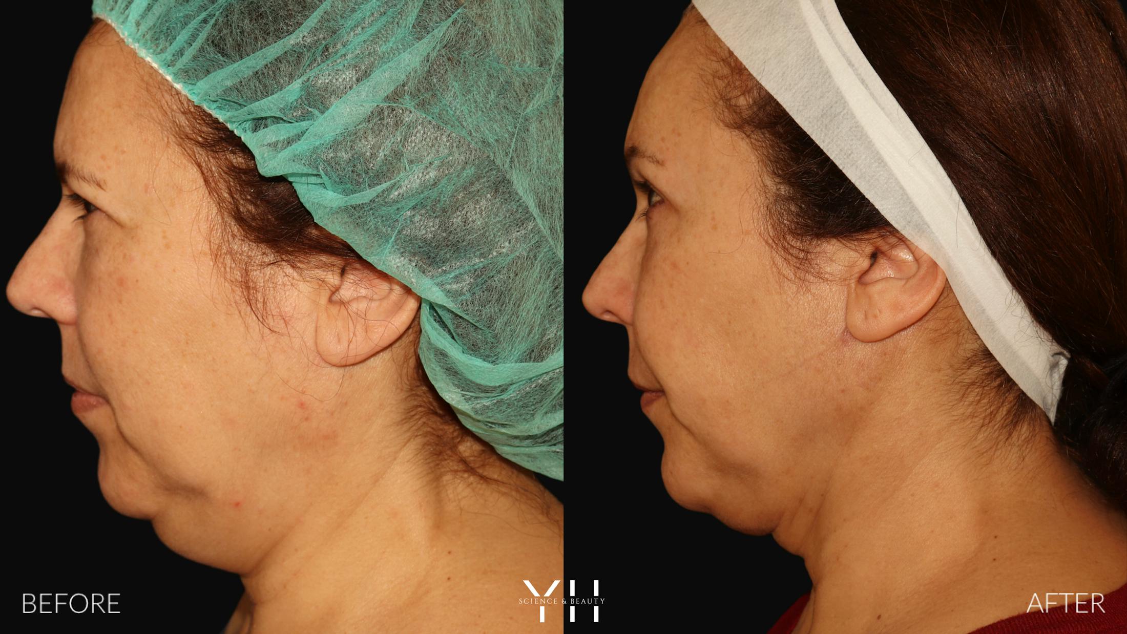 Necklift Before & After Gallery - Patient 212115 - Image 6