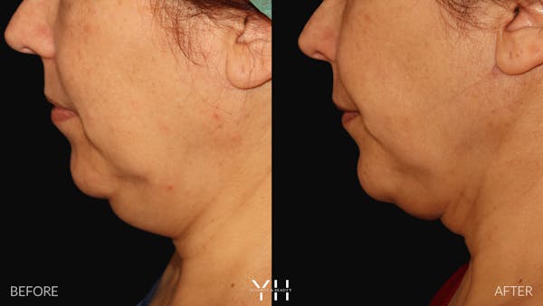 Necklift Before & After Gallery - Patient 212115 - Image 13