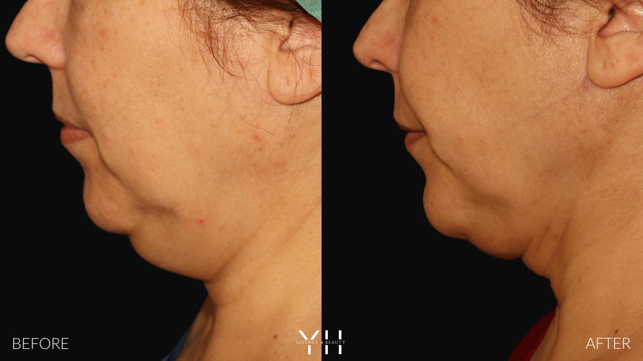 Necklift Before & After Gallery - Patient 212115 - Image 13