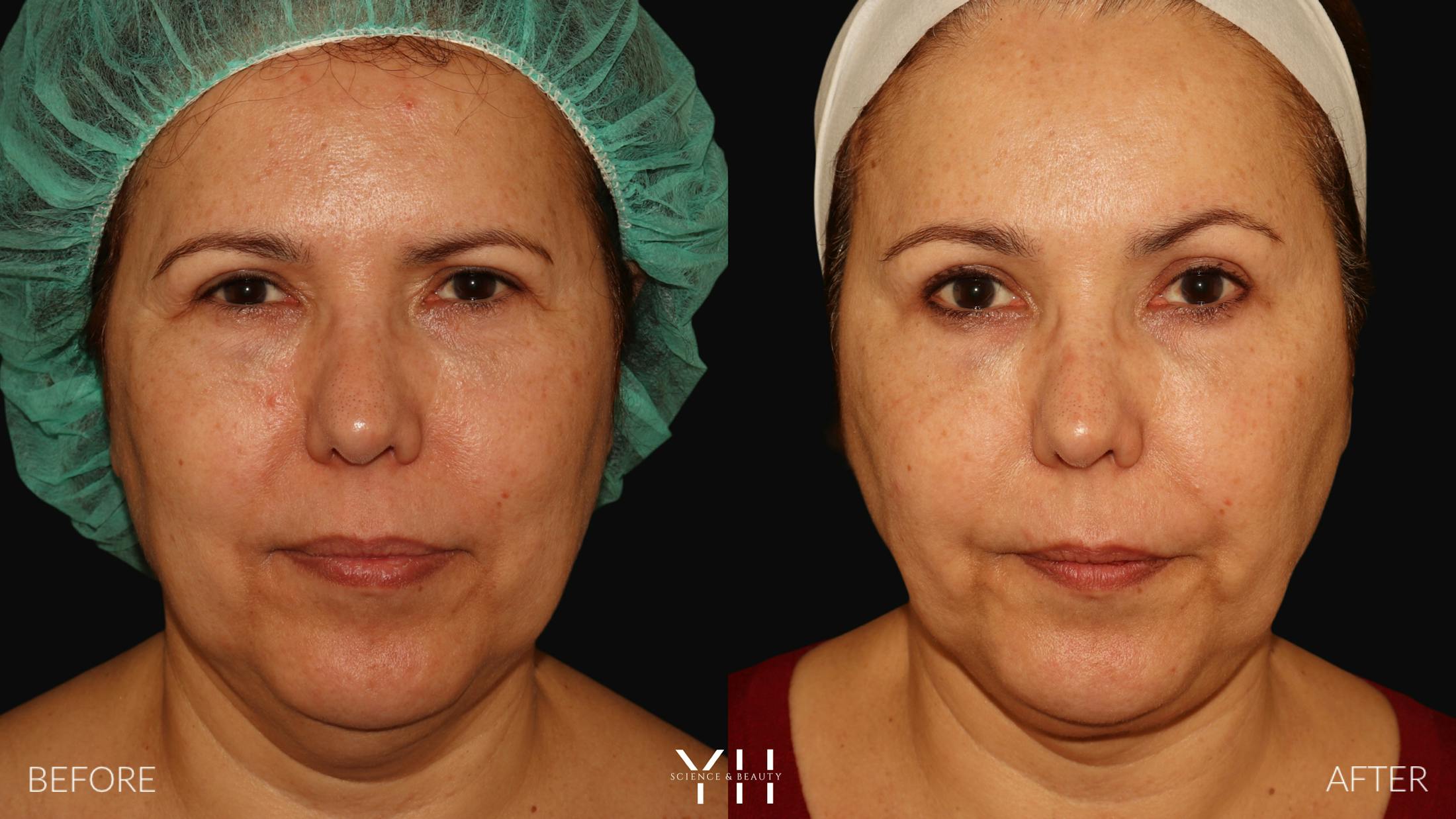 Necklift Before & After Gallery - Patient 212115 - Image 1