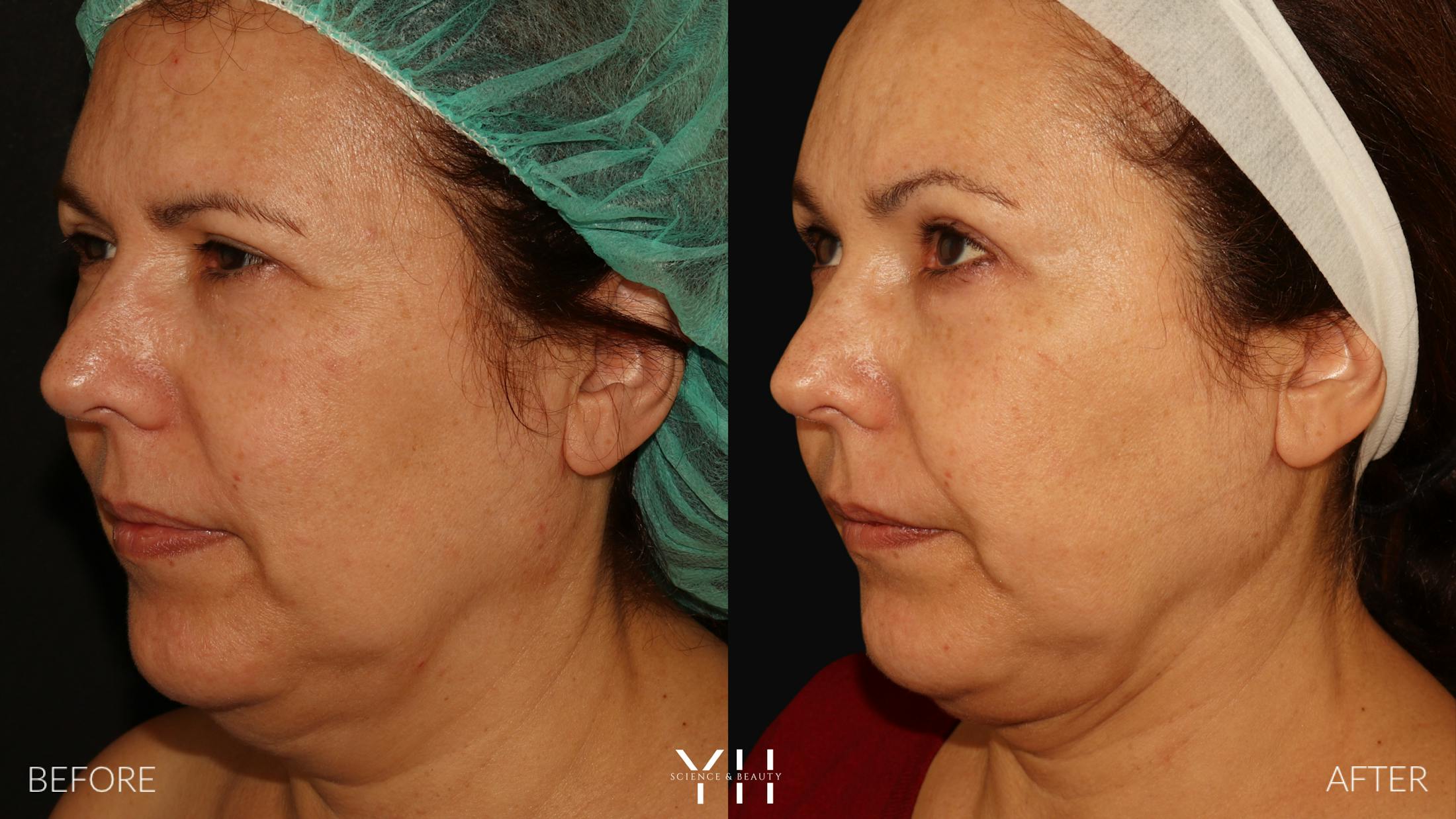 Necklift Before & After Gallery - Patient 212115 - Image 5