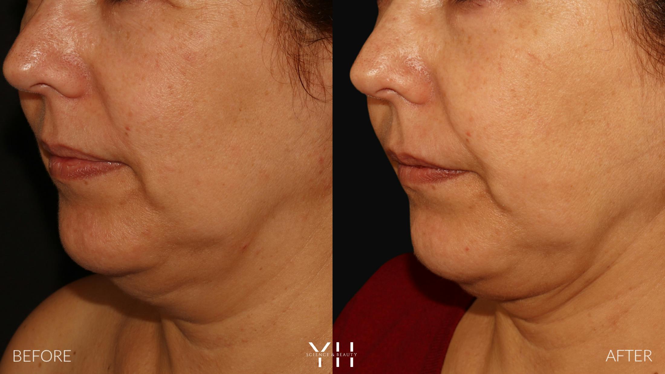 Necklift Before & After Gallery - Patient 212115 - Image 12