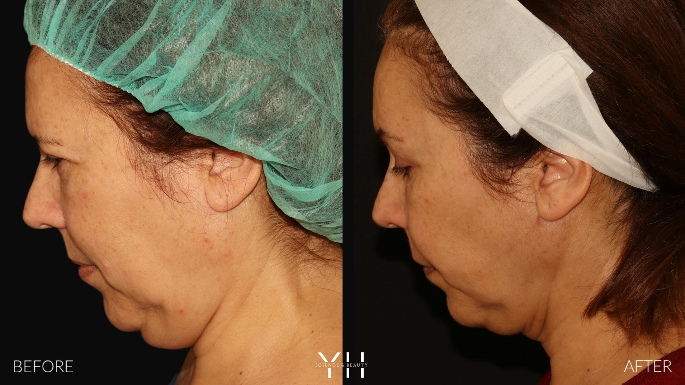 Necklift Before & After Gallery - Patient 212115 - Image 7