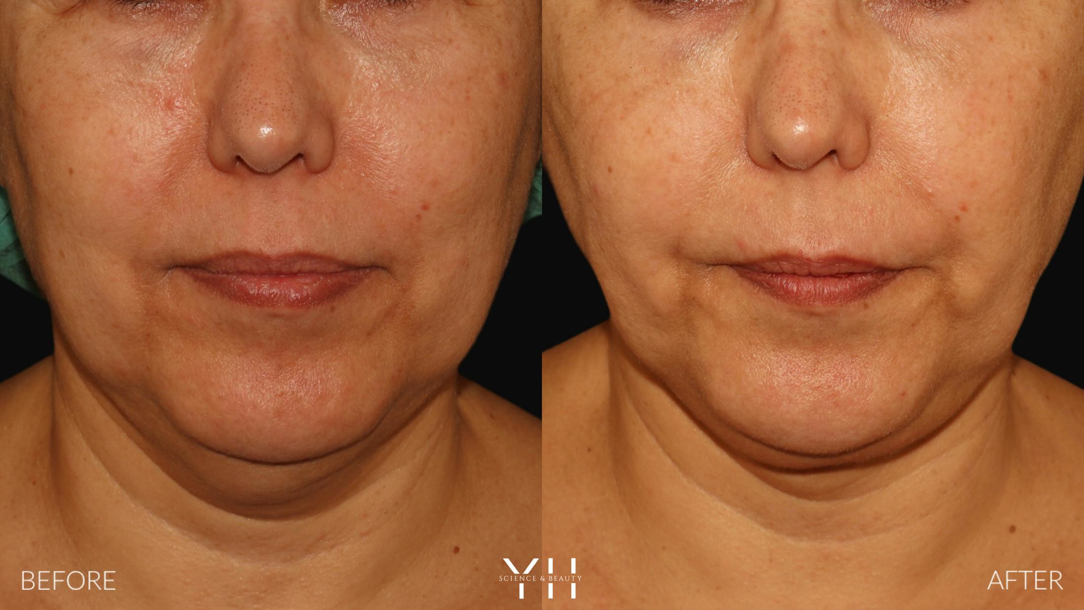 Necklift Before & After Gallery - Patient 212115 - Image 8