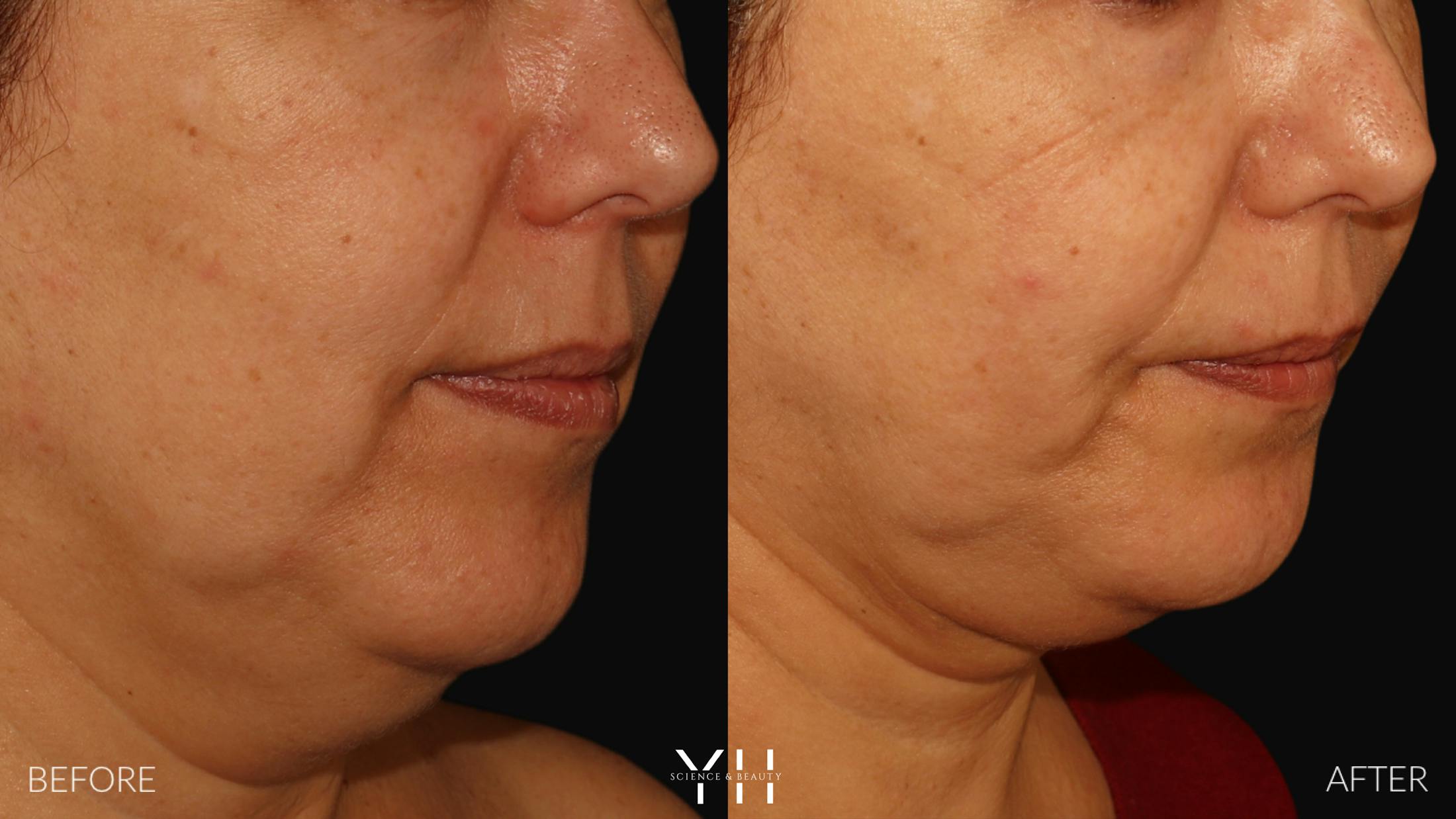 Necklift Before & After Gallery - Patient 212115 - Image 9