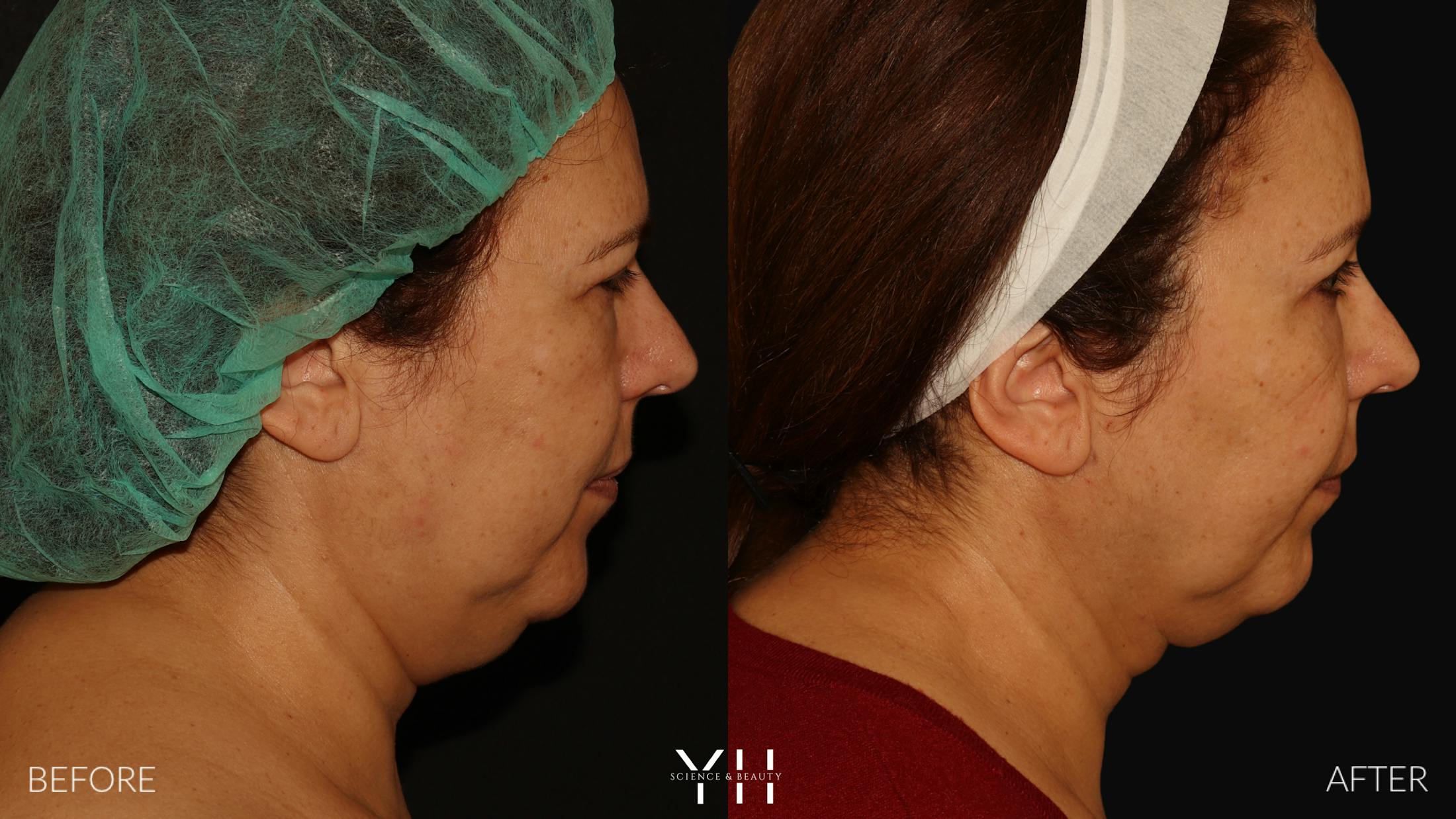 Necklift Before & After Gallery - Patient 212115 - Image 3