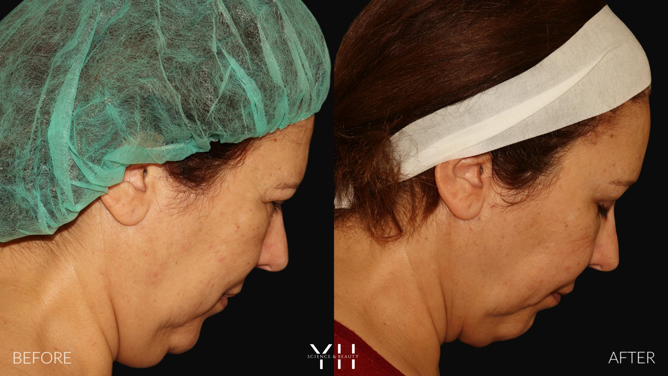 Necklift Before & After Gallery - Patient 212115 - Image 4