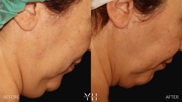 Necklift Before & After Gallery - Patient 212115 - Image 11