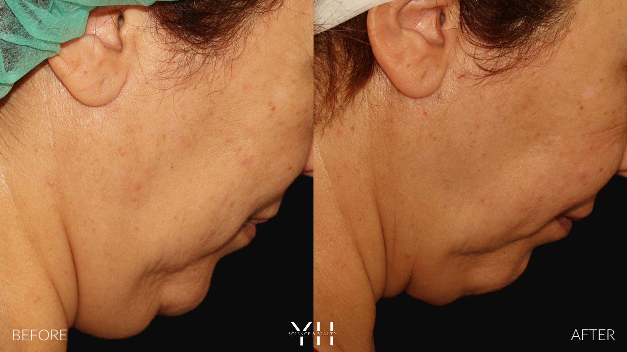 Necklift Before & After Gallery - Patient 212115 - Image 11