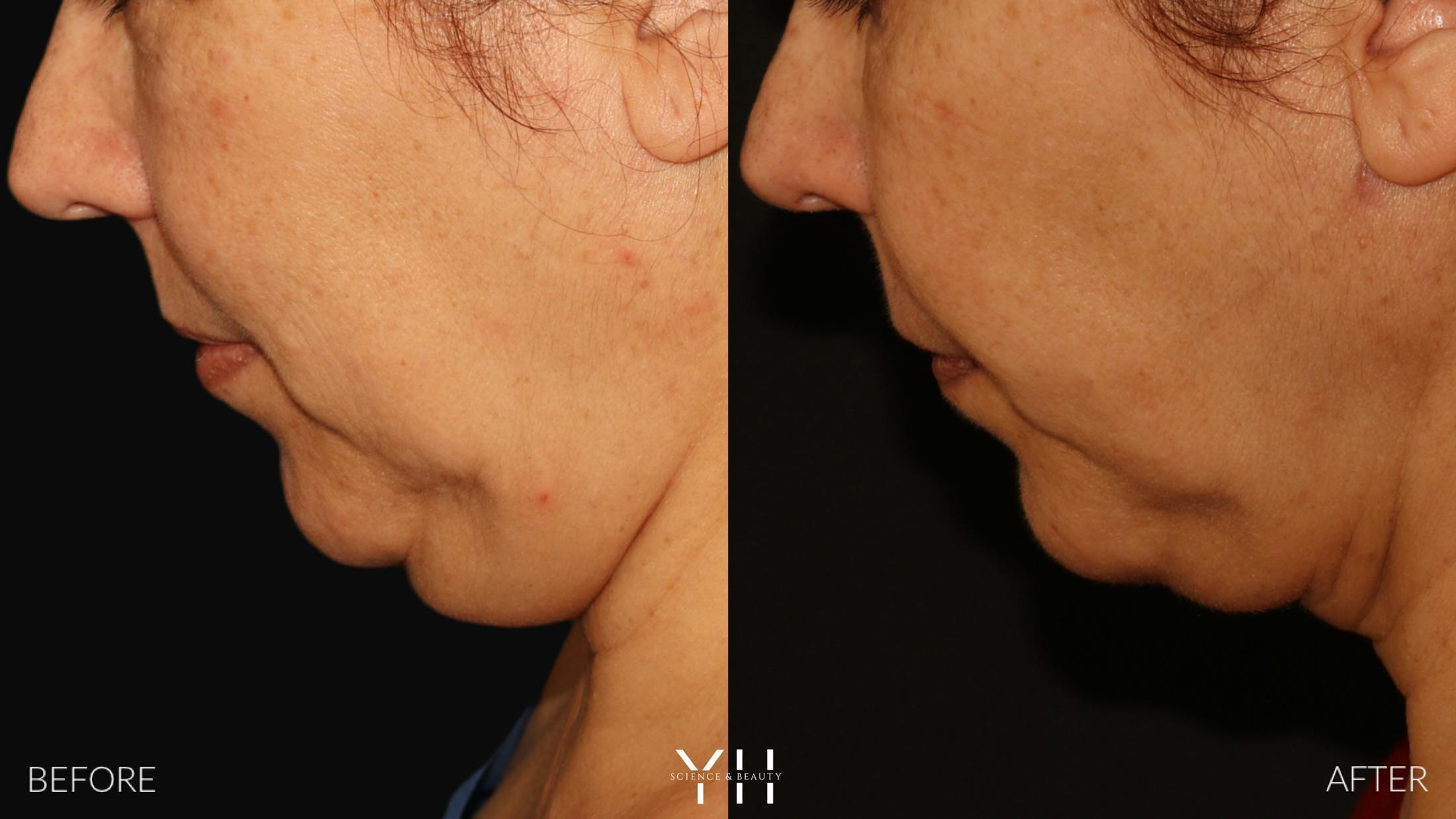 Necklift Before & After Gallery - Patient 212115 - Image 14